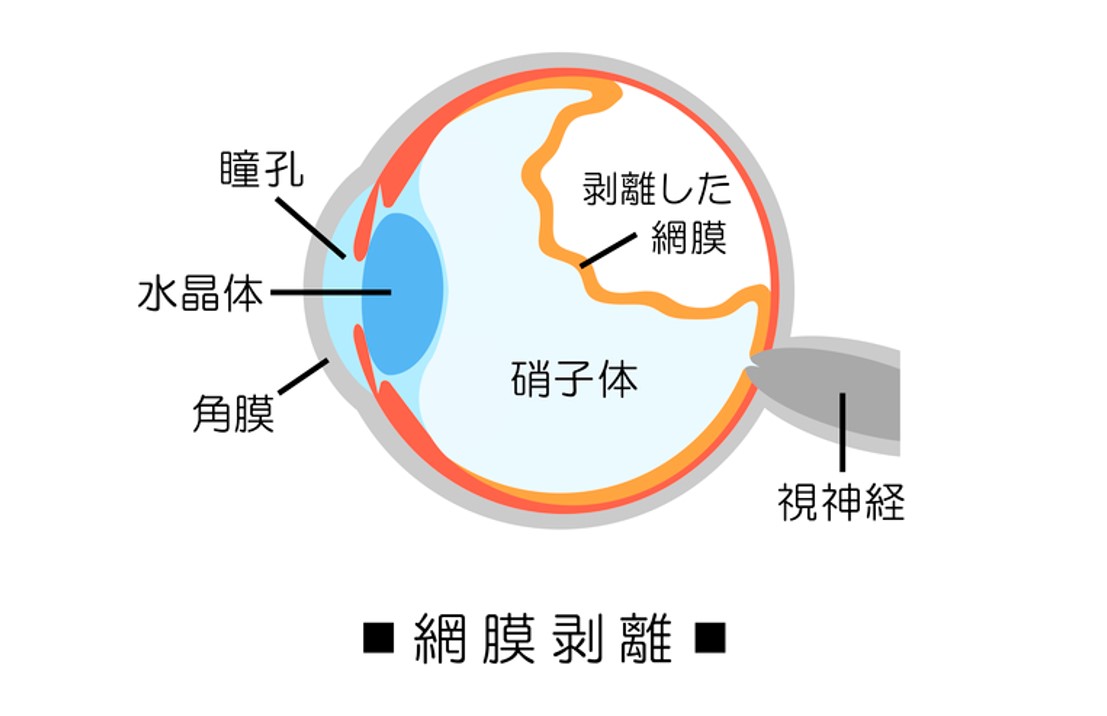 硝子体と網膜の関係