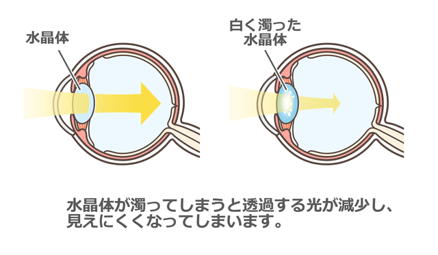 白内障手術のタイミングのイメージ