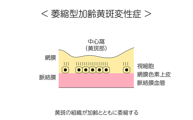 加齢黄斑変性委縮型