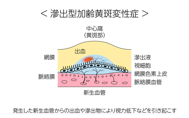 加齢黄斑変性