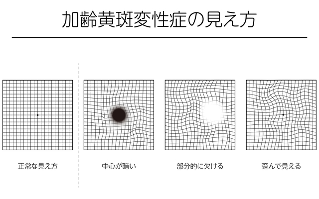 加齢黄斑変性の症状