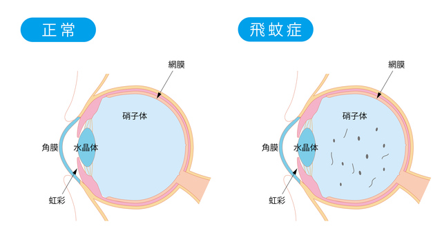 生理的飛蚊症