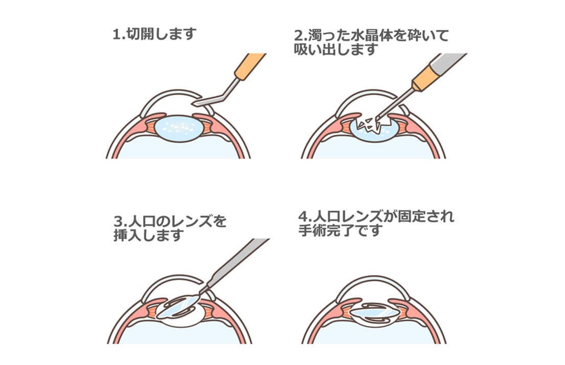 白内障手術のイメージ