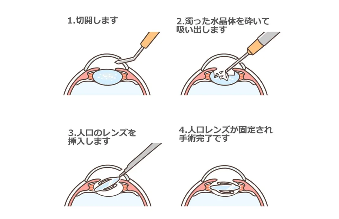 白内障手術のイメージ