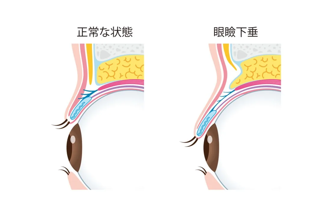 眼瞼下垂