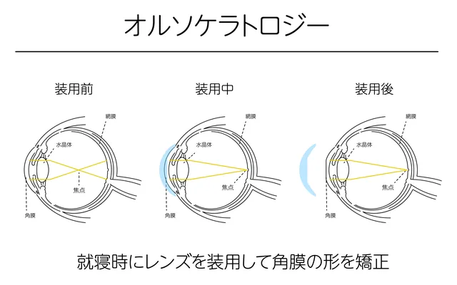 オルソケラトロジーの治療の仕組み